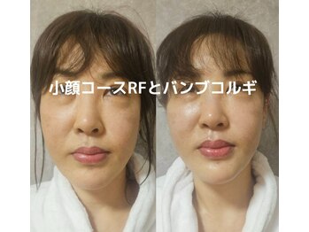 ローハ(ROHA)/小顔☆ラジオ波×バンブーコルギ