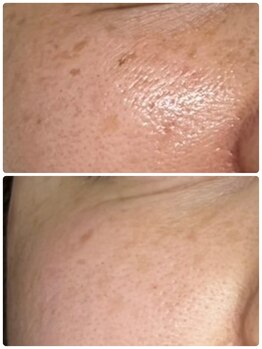 ギャラクシービューティー(galaxy beauty)/シミケア