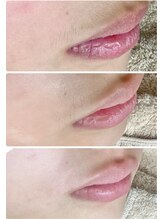 ミューシェリー(Mieux Cherie)/ジュニア脱毛は、7歳からOK