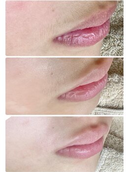 ミューシェリー(Mieux Cherie)/ジュニア脱毛は、7歳からOK