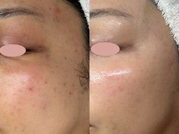 プレナ(PLENA)/オーダーメイド肌管理