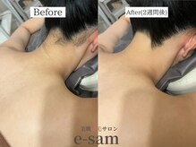 イーサム 高槻摂津富田店(e-sam)/丸ごと全身脱毛