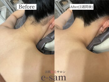 イーサム 高槻摂津富田店(e-sam)/丸ごと全身脱毛