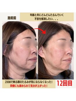 経堂鍼灸整体院/幹細胞美容鍼+小顔矯正