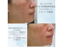 マリー エクラン/サロンケアは月1回