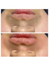 はだころも/キッズ脱毛 口周り