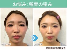 ナチュラルビューティーフェイス 横浜(NBF)/お悩み：頬骨 / 20代