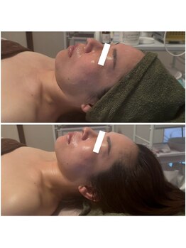 にっこりビューティー/★EMSマッサージ+エアバリ