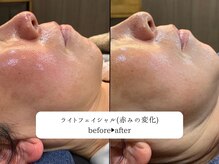 レオロ(leolo)/IPLライトフェイシャル