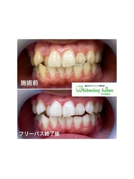 ホワイトニングサロン 名古屋駅店/【ホワイトニング施術例】