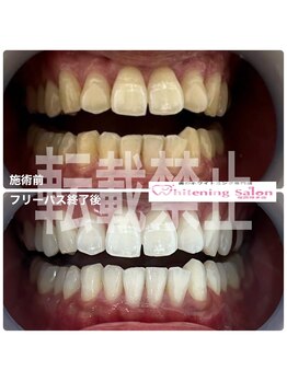 ホワイトニングサロン 福岡博多店/ホワイトニング