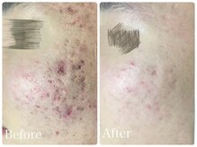 ロイヤル(ROYAL)/ニキビ改善症例