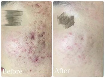 ロイヤル(ROYAL)/ニキビ改善症例