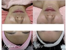 グランルリエ(Gran Rurier)/肌管理、超音波×ラジオ波shot 