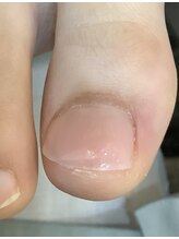 巻き爪ジェル