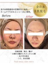 カリス(charis)/金の糸美肌脱毛