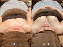 メディカルエース(MedicalAce)/バストアップ！