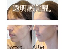 ルミライ(Lumirai)/たるみ改善|毛穴|フェイシャル