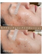 リブラン(Libran)/しわに内側からアプローチ★