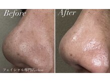 シェーン(Schon)/IPL美肌光フォト