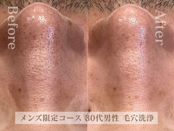 グラツィア 福岡天神地下街店の写真/メンズ限定&大人気!!【毛穴・ザラつき・テカリ改善◆ヒト幹細胞】ニキビケアやくすみの改善効果◎[天神駅]