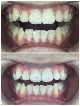 グラスプレイス/プレミアム症例 5