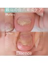 フット自爪育成(親指) ￥3,980～