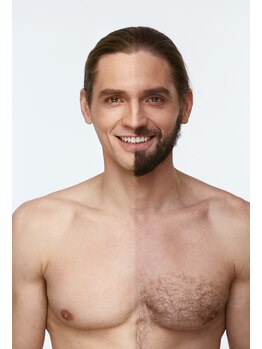 ジュエルオーキッド(Jewel orchids)/メンズ脱毛