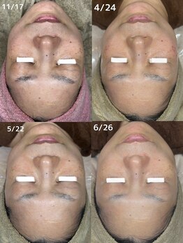 ベル(Belle)/シミケアハーブピーリング¥9,800