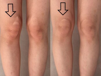 ピエモワ 渋谷(PiEmoi)/O脚X脚のお悩みにも!