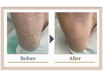 巻き爪補正店 錦糸町店/【踵ケア】