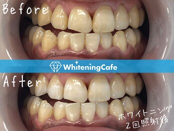 ホワイトニングカフェ 松本店(WhiteningCafe)/ホワイトニングビフォーアフター