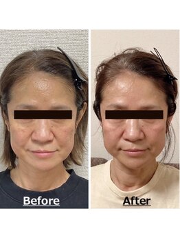 小顔22 ボルティ 赤坂支店(Bolty)/50代：施術10回