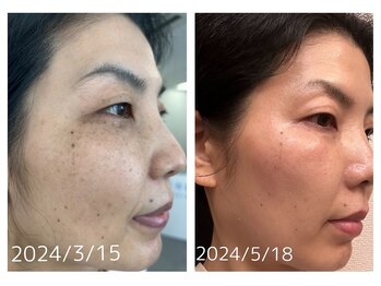 吉宗指圧治療院/ダイヤモンドピールbefore after