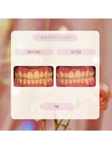 プラスビーセルフ(+b self)/ホワイトニングビフォーアフター