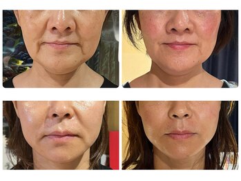 ねこのひげ/お顔の変化