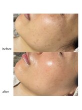 ルアラナ(Lualana)/お手入れ半年の変化