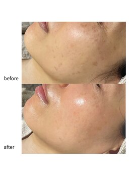 ルアラナ(Lualana)/お手入れ半年の変化