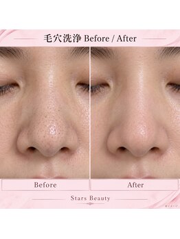 スターズ(Stars)の写真/【☆毛穴洗浄&フェイシャルコース60分￥5980】毛穴の黒ずみを改善!キメを整え透明感溢れるお肌へ!