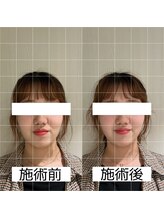 ヴィーライン 大阪梅田院(VeLine)/鍼灸／美容鍼／小顔／大阪／梅田