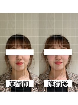 ヴィーライン 大阪梅田院(VeLine)/鍼灸／美容鍼／小顔／大阪／梅田