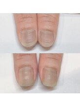 アーラ バイ ヴィアルーチェ(aLa by VIALUCE)/自爪育成