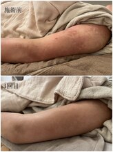 エミュ(emu)/ハーブケア &nbsp;お客様before/after