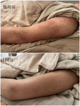 エミュ(emu)/ハーブケア &nbsp;お客様before/after