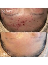 エピロマ(EPILOMA)/鹿児島/宇宿/肌質改善