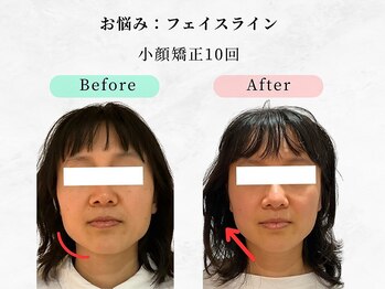 美容整体 ウェリナ 蟹江院/.【小顔矯正before→after】