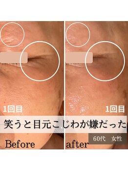 パルティノ 高崎店/笑う度に目元小じわ緩和したい