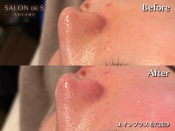 サロン ド エス アオヤマ(SALON DE S AOYAMA)の写真/青山・外苑前で毛穴洗浄。最新マシンで汚れを徹底除去し、LDMで潤いUP。黒ずみ・開きを改善し美肌へ。