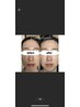 【韓国肌管理】無添加天然ハーブピーリング/剥離なし/肌艷UP/¥6600