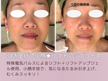 アマテ(Amate)/リフトアップコースが大人気！